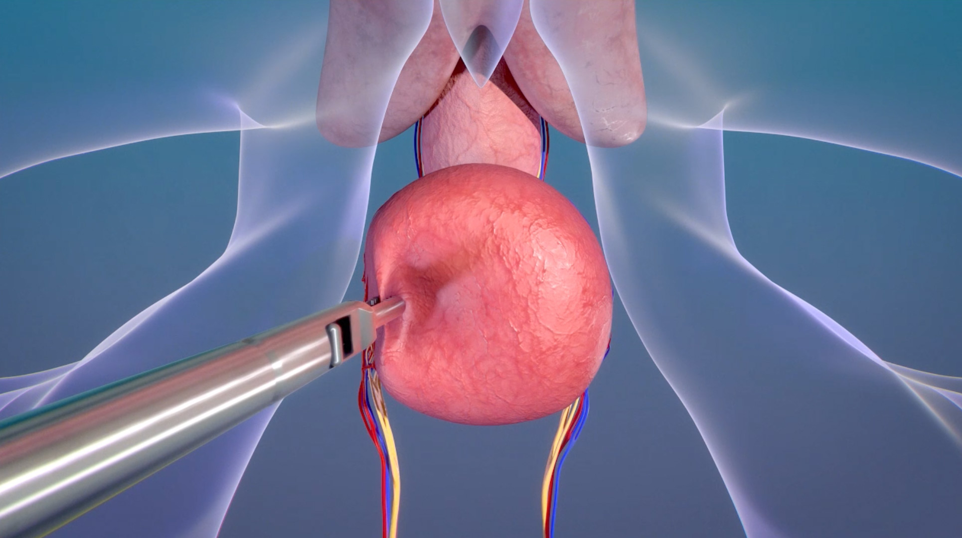 Levita® Magnetics Announces Expanded Indication of Magnetic Surgical System  for Use in Prostatectomy Procedures - Magnetic Surgery
