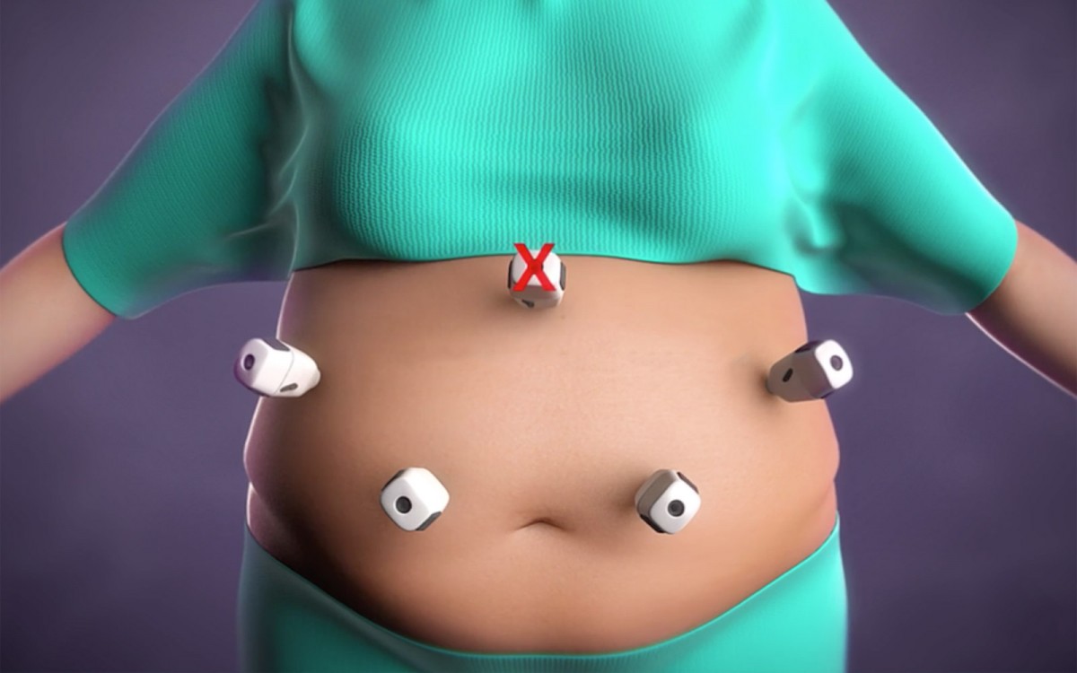 Magnetic surgery abdominal incisions